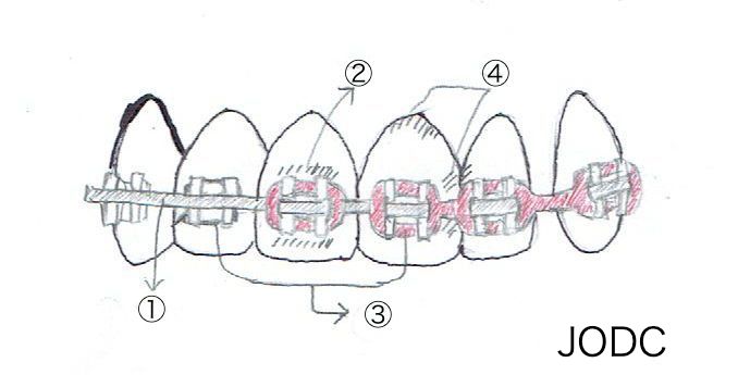 Jun S News Vol 9 テーマ 矯正装置装着時のブラッシング 甲府市の矯正歯科 純矯正歯科クリニック