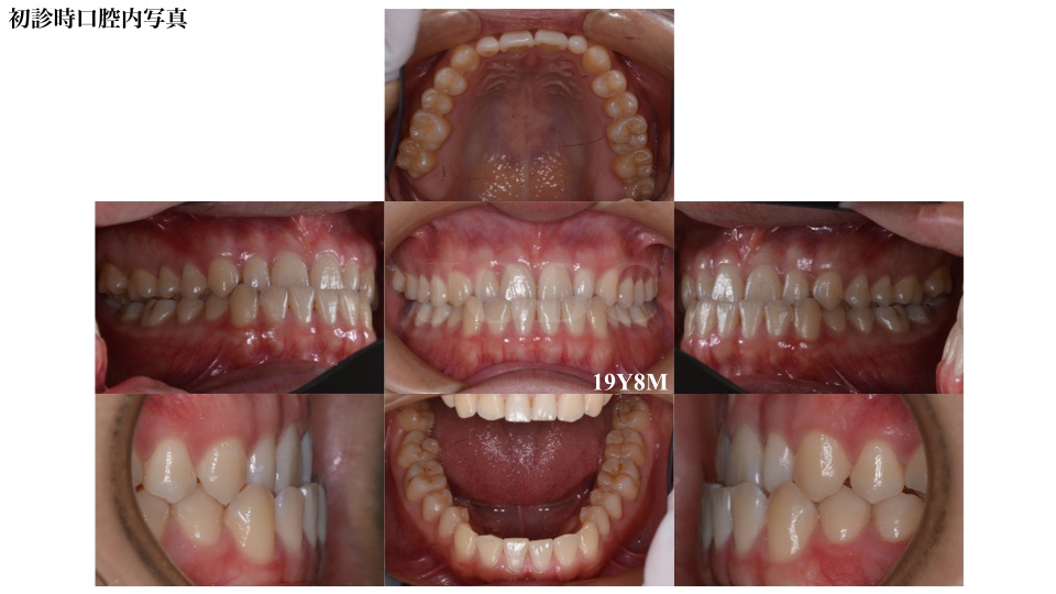 ハーフリンガル代男性f様矯正日記 甲府市の矯正歯科 純矯正歯科クリニック