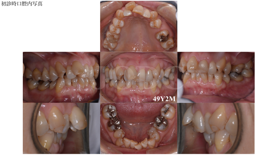 フルリンガル40代女性o様矯正日記 甲府市の矯正歯科 純矯正歯科クリニック