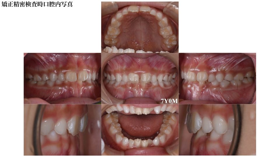 小児矯正(第一期治療)女性M様矯正症例 | 甲府市の矯正歯科「純矯正歯科  