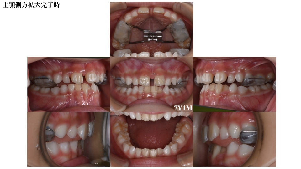 小児矯正(第一期治療)女性M様矯正症例 | 甲府市の矯正歯科「純矯正歯科  