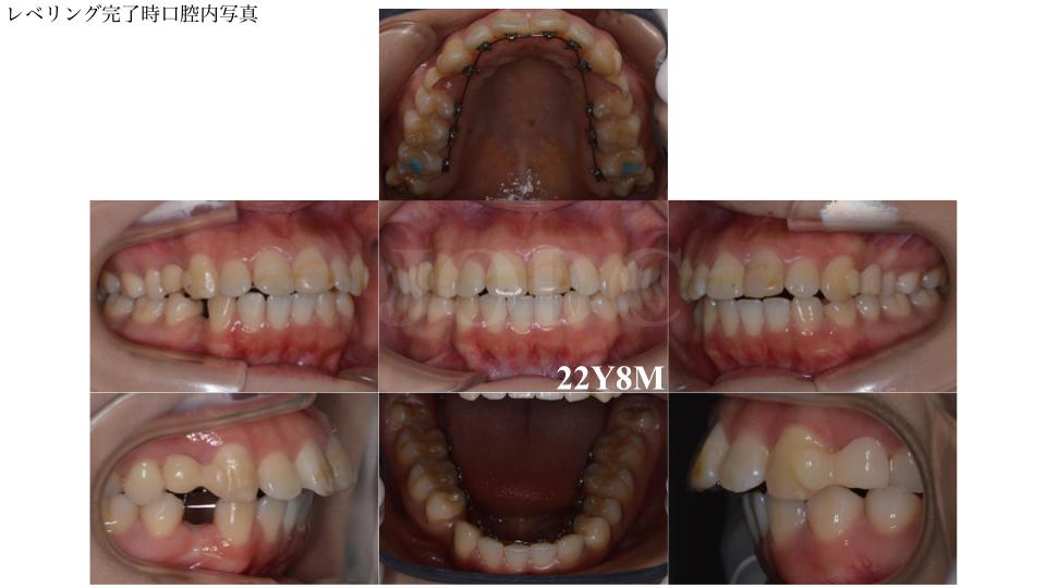 臨床の疑問に答える リンガルブラケット矯正Q&A60 臨床の疑問に答える！ リンガルブラケット矯正Q\u0026A60／医歯薬出版株式会社